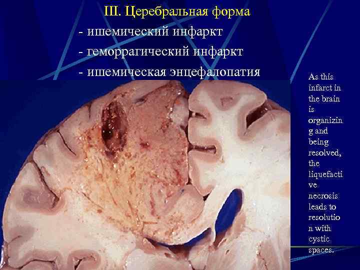 III. Церебральная форма - ишемический инфаркт - геморрагический инфаркт - ишемическая энцефалопатия As this