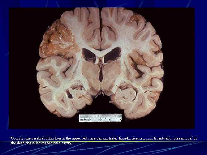 Grossly, the cerebral infarction at the upper left here demonstrates liquefactive necrosis. Eventually, the