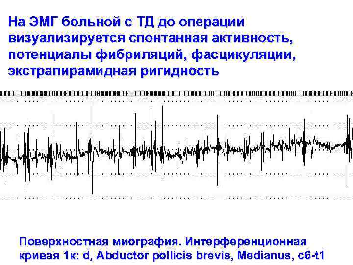 На ЭМГ больной с ТД до операции визуализируется спонтанная активность, потенциалы фибриляций, фасцикуляции, экстрапирамидная