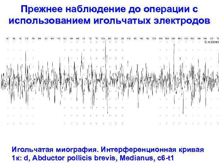 Прежнее наблюдение до операции с использованием игольчатых электродов Игольчатая миография. Интерференционная кривая 1 к: