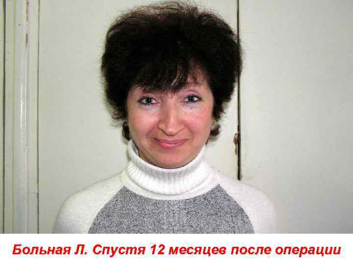 Больная Л. Спустя 12 месяцев после операции 