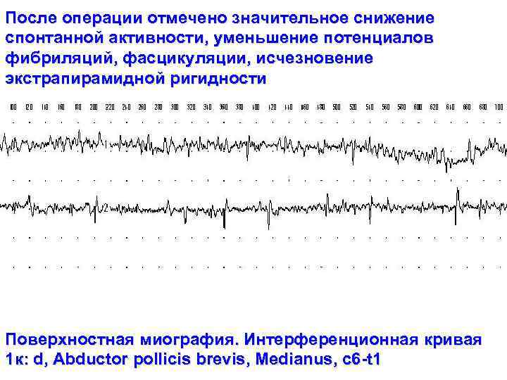 После операции отмечено значительное снижение спонтанной активности, уменьшение потенциалов фибриляций, фасцикуляции, исчезновение экстрапирамидной ригидности