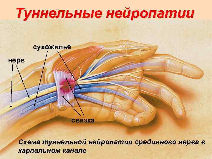 Туннельная нейропатия. Карпальный туннельный синдром стопы. Туннельный синдром лучевого нерва. Туннельный карпальный синдром руки. Туннельная нейропатия срединного нерва.
