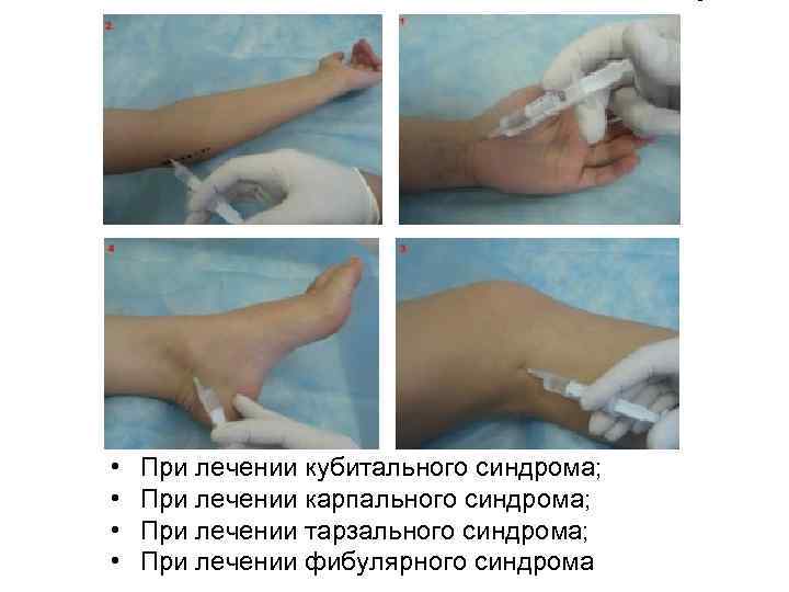  • • При лечении кубитального синдрома; При лечении карпального синдрома; При лечении тарзального