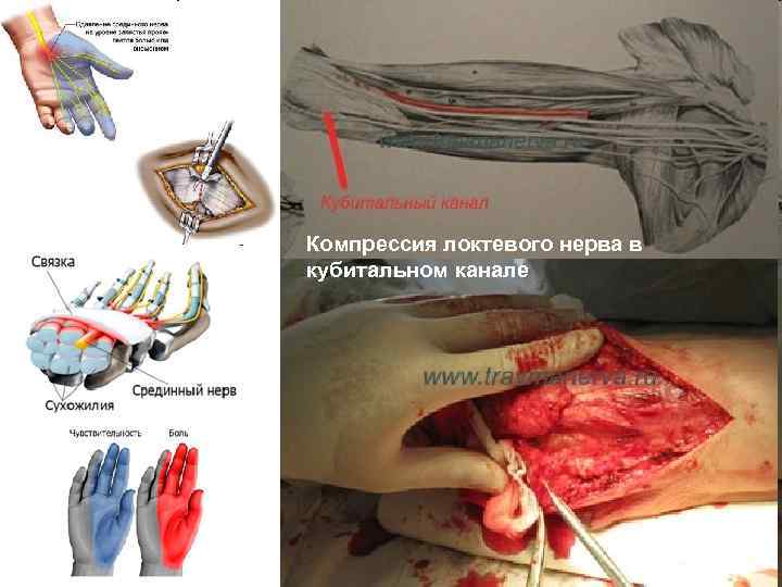 Компрессия локтевого нерва в кубитальном канале 
