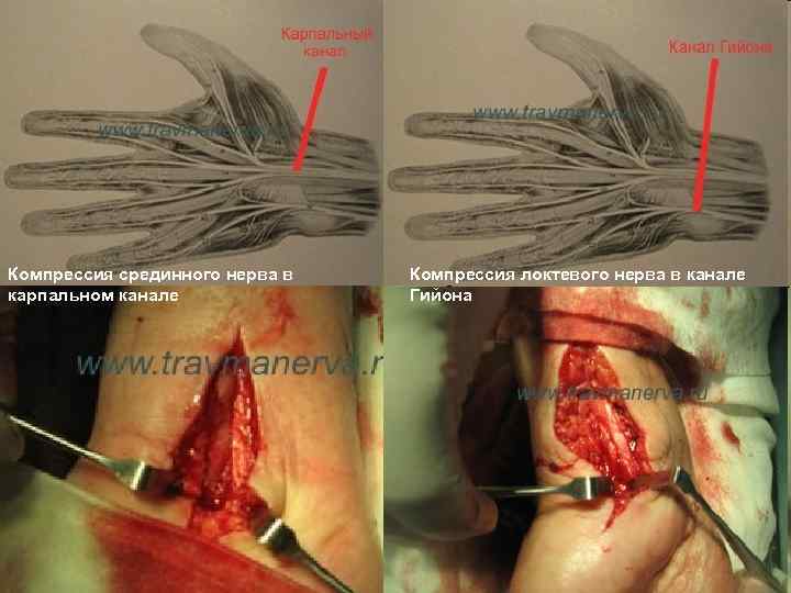 Компрессия срединного нерва в карпальном канале Компрессия локтевого нерва в канале Гийона 