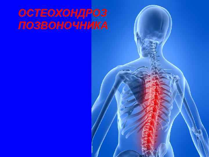 ОСТЕОХОНДРОЗ ПОЗВОНОЧНИКА 