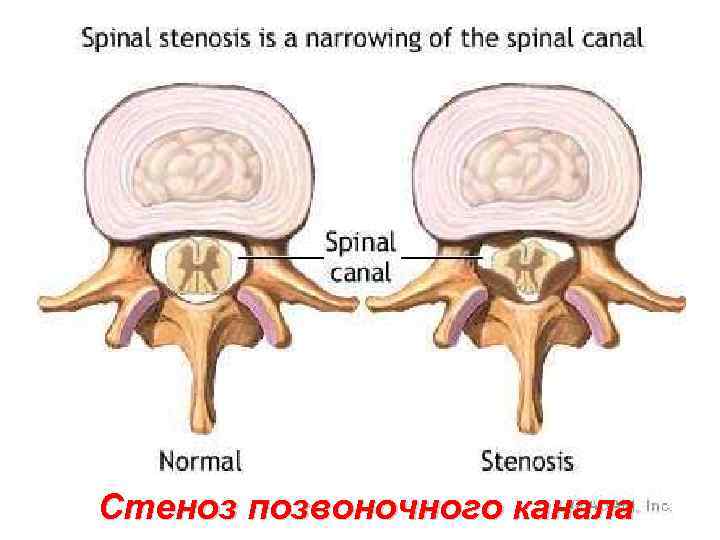 Стеноз позвоночного канала 