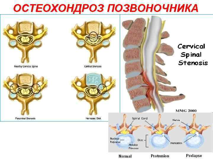 ОСТЕОХОНДРОЗ ПОЗВОНОЧНИКА 