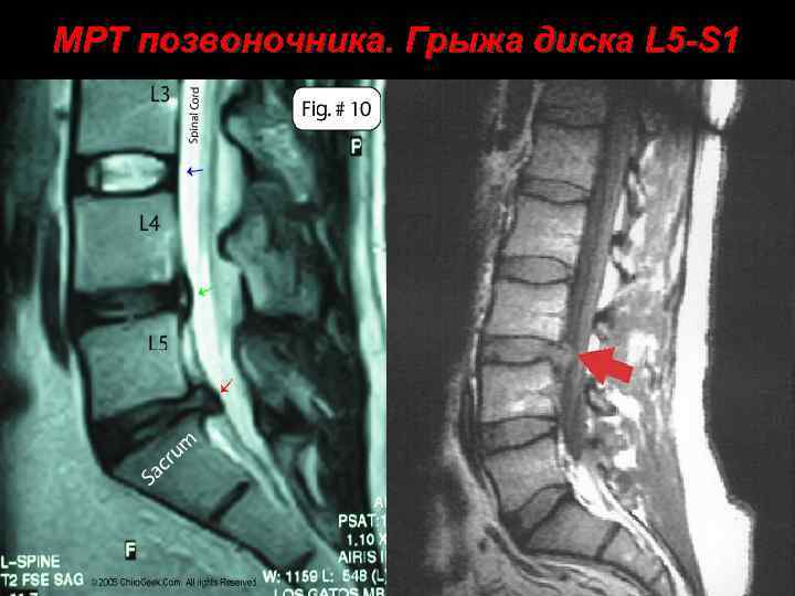 МРТ позвоночника. Грыжа диска L 5 -S 1 