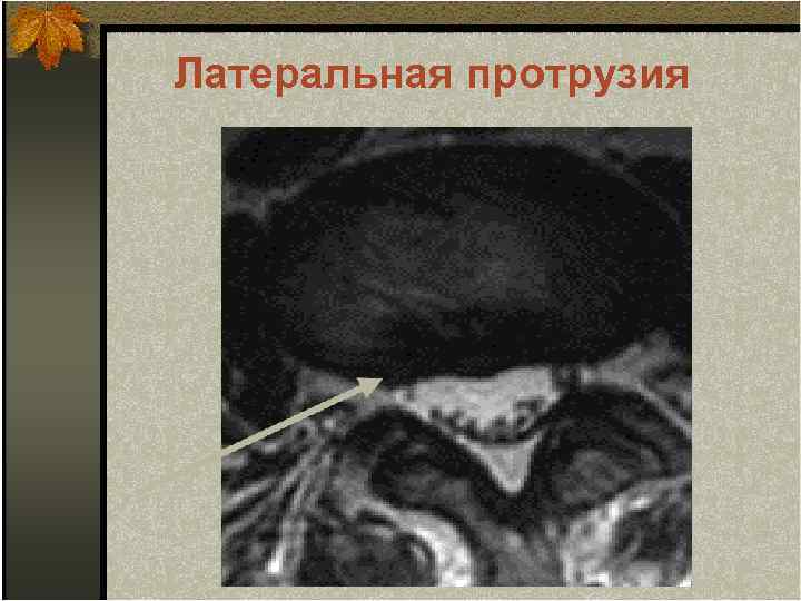 Латеральная протрузия 
