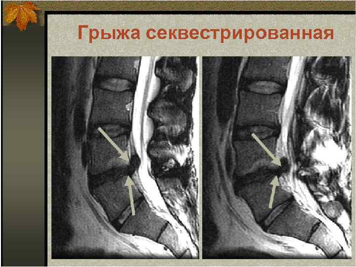 Грыжа секвестрированная 