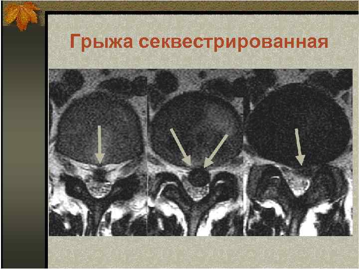 Грыжа секвестрированная 