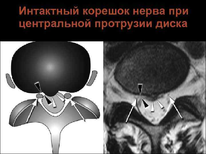 Интактный корешок нерва при центральной протрузии диска 