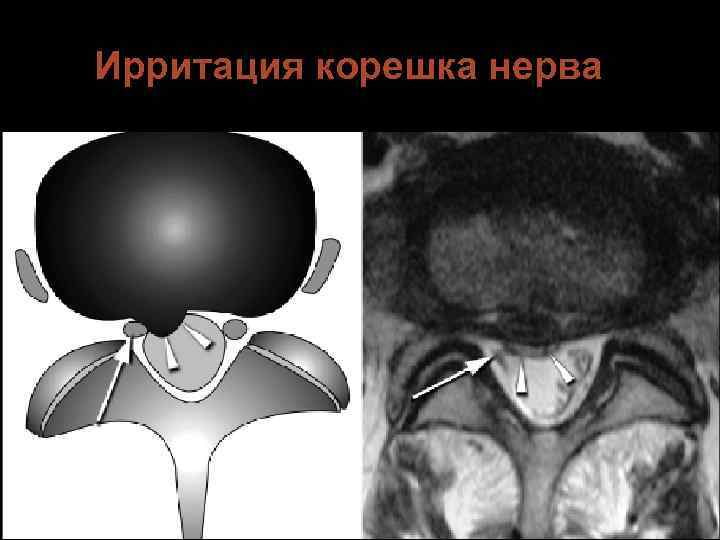 Ирритация корешка нерва 
