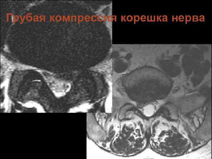 Грубая компрессия корешка нерва 