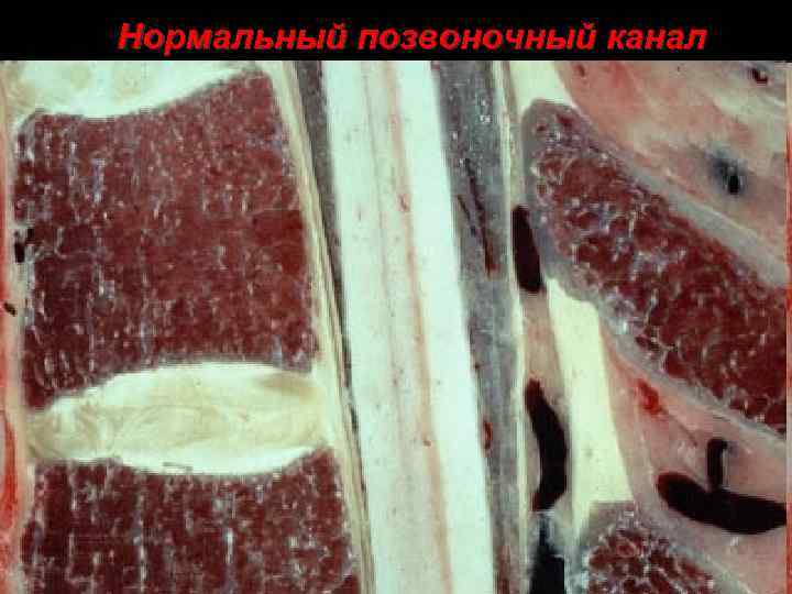Нормальный позвоночный канал 