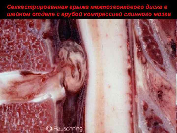 Секвестрированная грыжа межпозвонкового диска в шейном отделе с грубой компрессией спинного мозга 