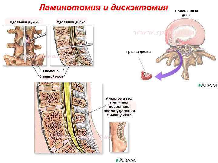 Ламинотомия и дискэктомия 