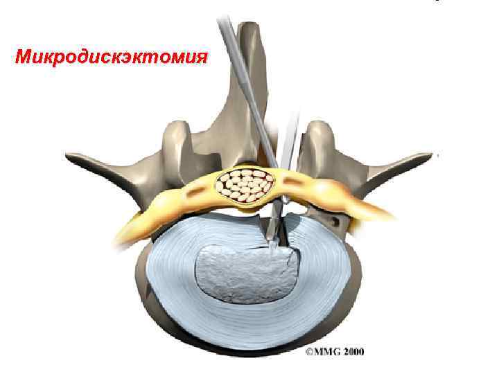 Микродискэктомия 
