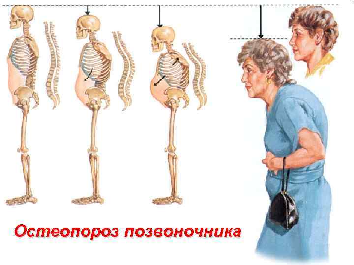 Остеопороз позвоночника 