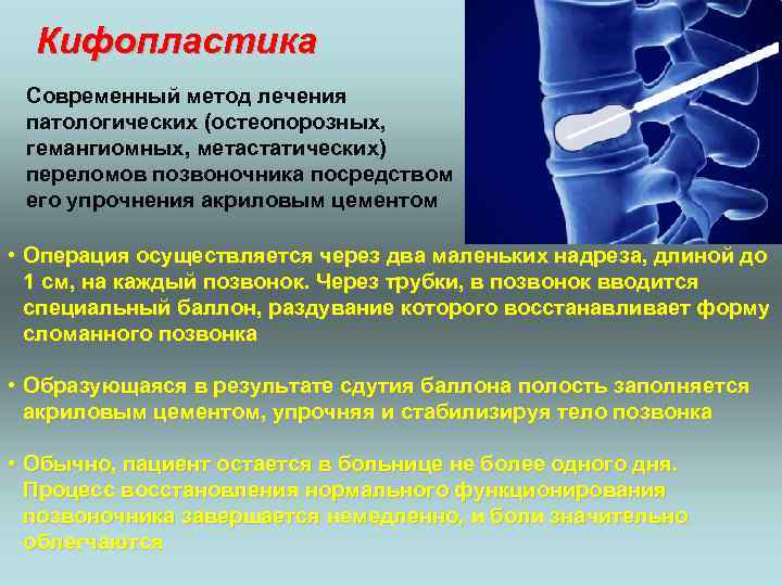 Кифопластика Современный метод лечения патологических (остеопорозных, гемангиомных, метастатических) переломов позвоночника посредством его упрочнения акриловым