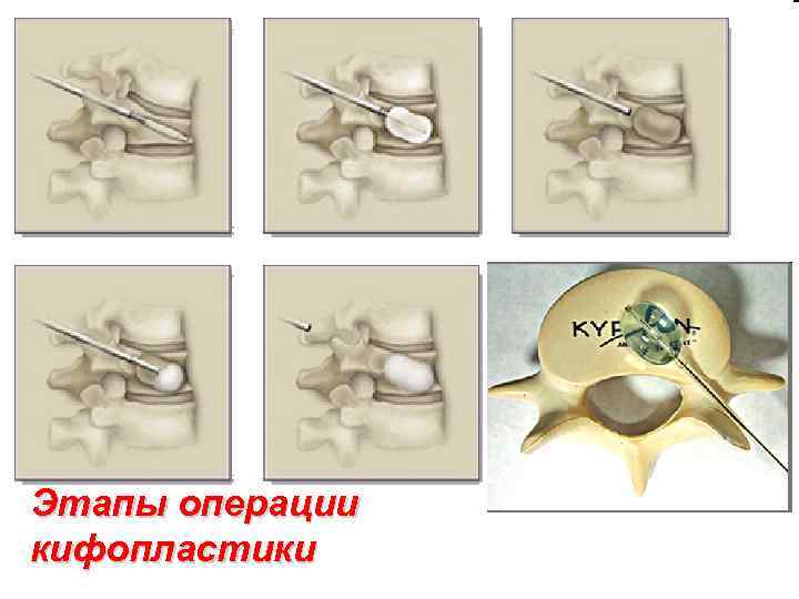 Этапы операции кифопластики 