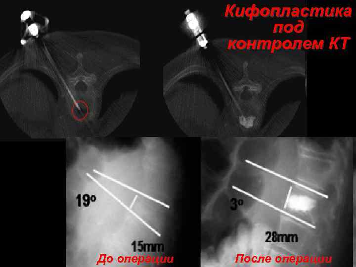 Кифопластика под контролем КТ До операции После операции 