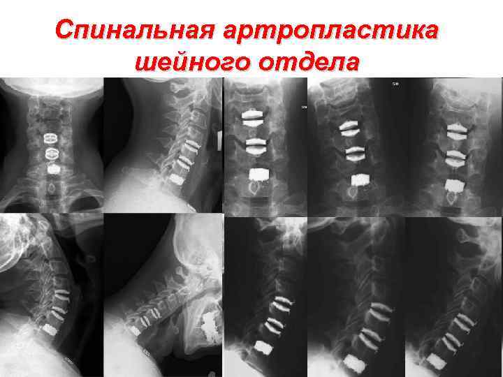 Спинальная артропластика шейного отдела 