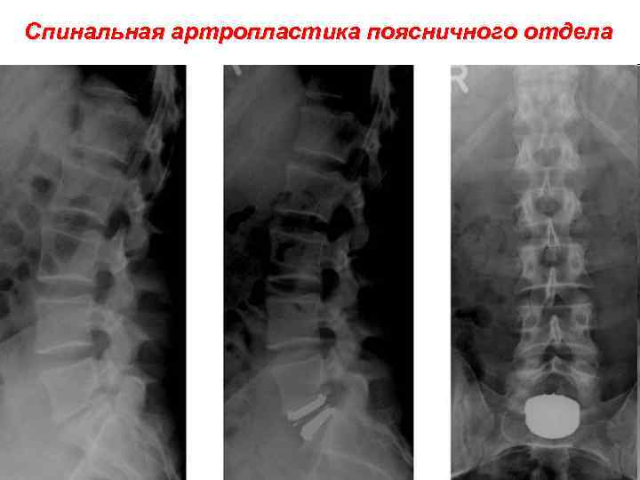 Спинальная артропластика поясничного отдела 