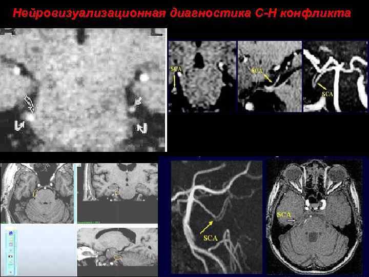 Нейровизуализационная диагностика С-Н конфликта 