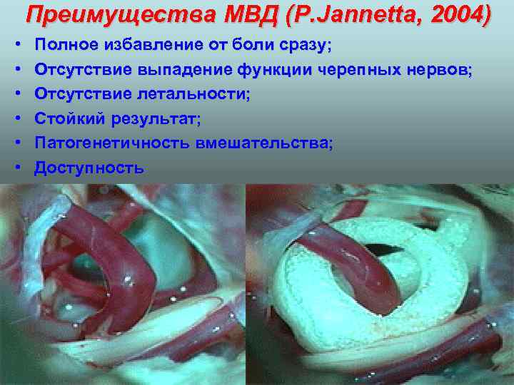 Преимущества МВД (P. Jannetta, 2004) • • • Полное избавление от боли сразу; Отсутствие