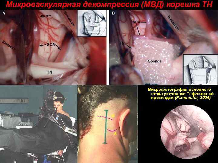 Микроваскулярная декомпрессия (МВД) корешка ТН Микрофотография основного этапа установки Тефлоновой прокладки (P. Jannetta, 2004)