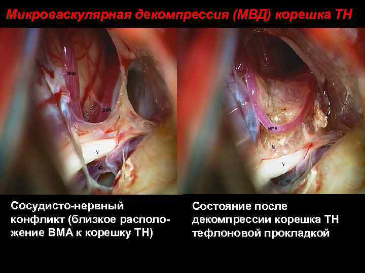 Микроваскулярная декомпрессия (МВД) корешка ТН Сосудисто-нервный конфликт (близкое расположение ВМА к корешку ТН) Состояние