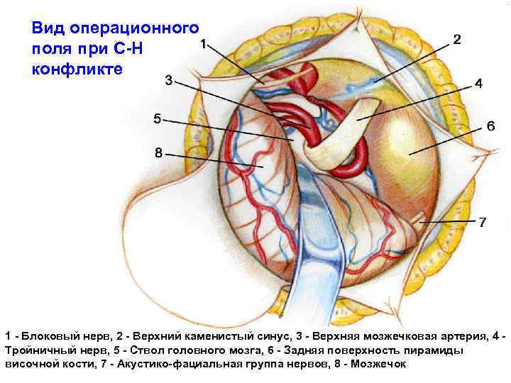 Вид операционного поля при С-Н конфликте 1 - Блоковый нерв, 2 - Верхний каменистый