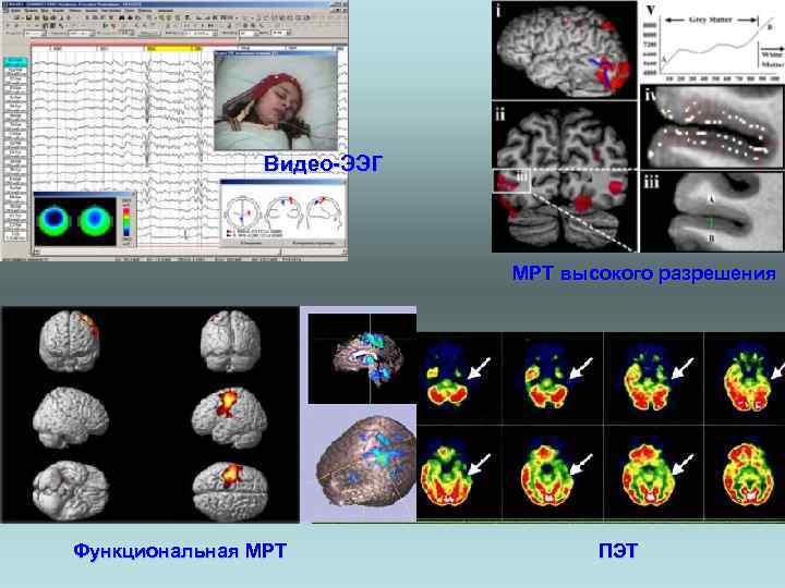 Видео-ЭЭГ МРТ высокого разрешения Функциональная МРТ ПЭТ 