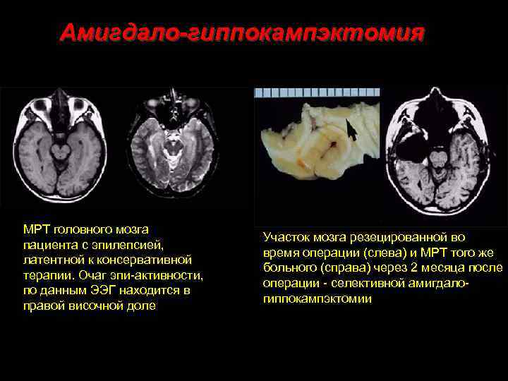 Амигдало-гиппокампэктомия МРТ головного мозга пациента с эпилепсией, латентной к консервативной терапии. Очаг эпи-активности, по