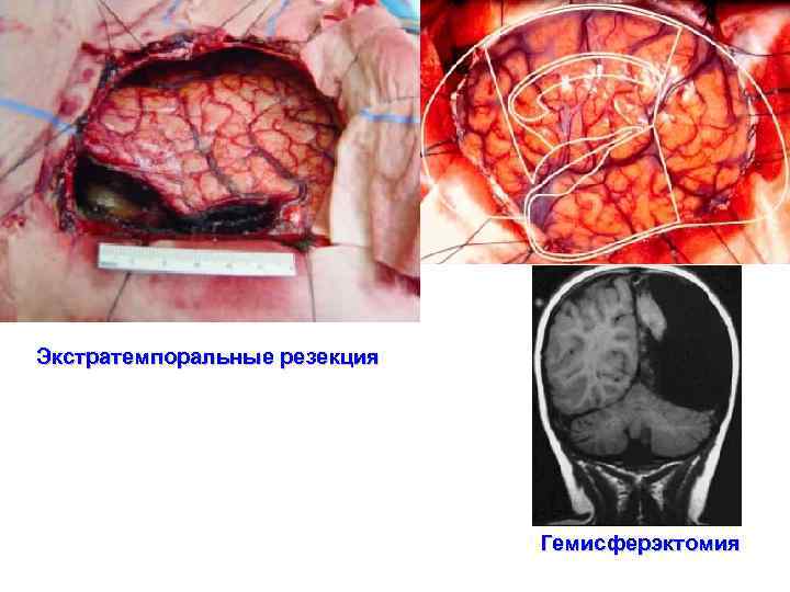 Экстратемпоральные резекция Гемисферэктомия 