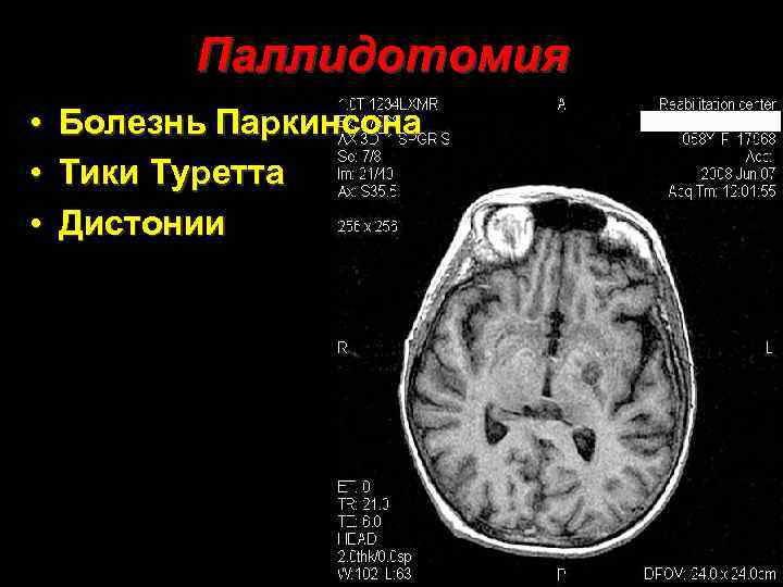 Таламотомия при болезни Паркинсона. Паркинсон мрт. Мрт при синдроме Туретта.