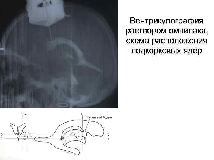 Вентрикулография раствором омнипака, схема расположения подкорковых ядер 