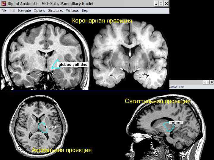 Коронарная проекция Сагиттальная проекция Аксиальная проекция 