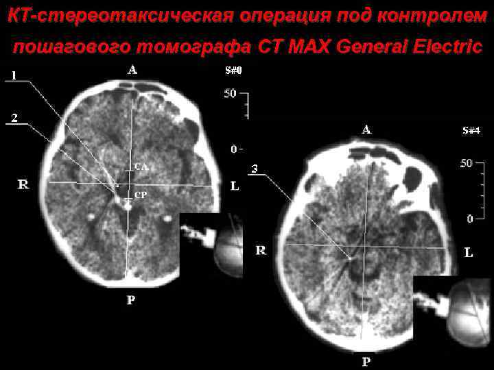 КТ-стереотаксическая операция под контролем пошагового томографа CT MAX General Electric 