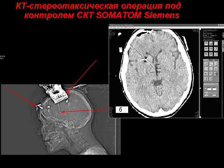 КТ-стереотаксическая операция под контролем СКТ SOMATOM Siemens 