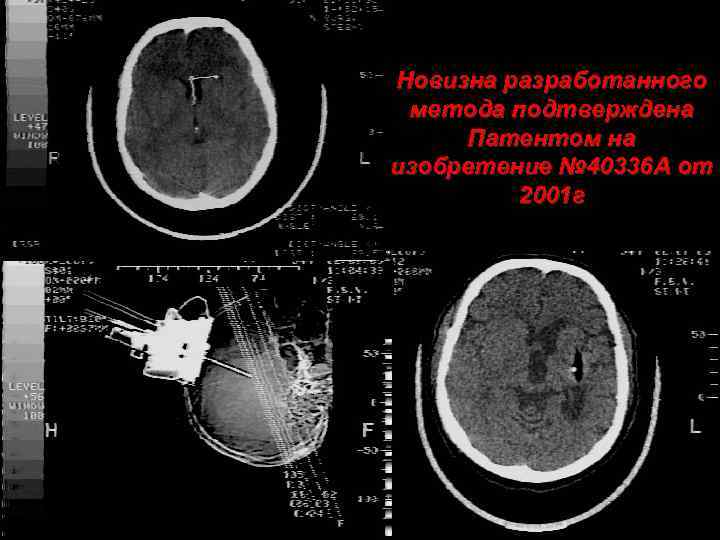 Новизна разработанного метода подтверждена Патентом на изобретение № 40336 А от 2001 г 
