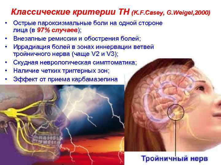 Классические критерии ТН (K. F. Casey, G. Weigel, 2000) • Острые пароксизмальные боли на