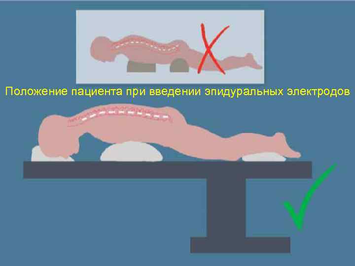 Положение пациента при введении эпидуральных электродов 