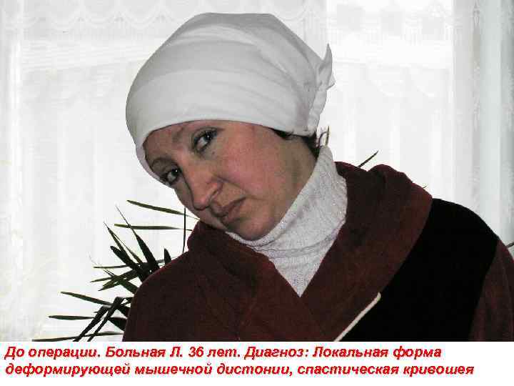 До операции. Больная Л. 36 лет. Диагноз: Локальная форма деформирующей мышечной дистонии, спастическая кривошея