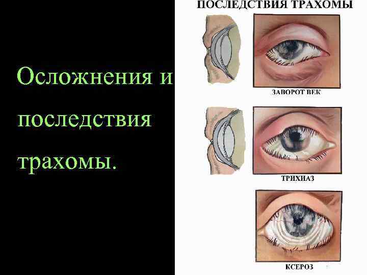 Осложнения и последствия трахомы. 