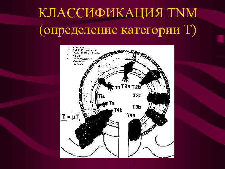 КЛАССИФИКАЦИЯ TNM (определение категории Т) 