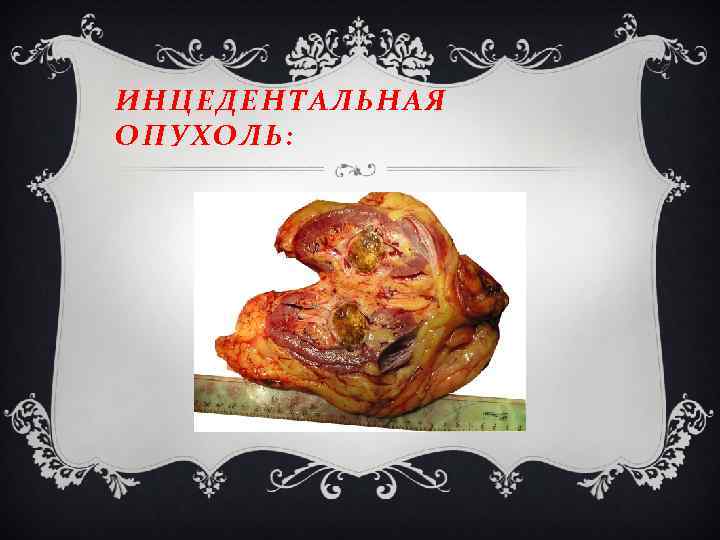 ИНЦЕДЕНТАЛЬНАЯ ОПУХОЛЬ: 